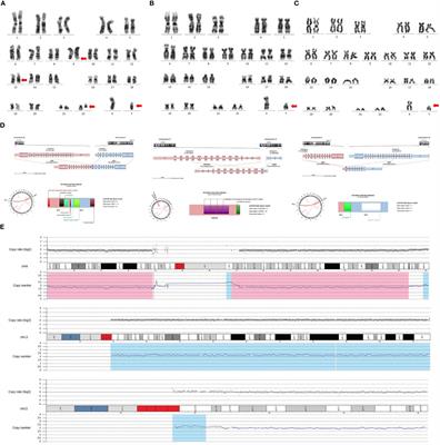 Familial 46, XY Disorder of Sexual Development identified in a Ph+BCR::ABL1P210+ Acute Lymphoblastic Leukemia septuagenarian female with RCBTB2::LPAR6 fusion gene: a case report